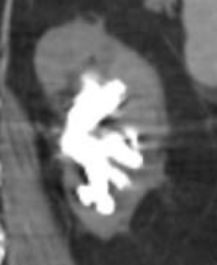Staghorn calculi (picture) → can be a nidus for UTIs