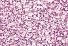 Renal Cell Carcinoma
- Originates from proximal tubule cells → polygonal clear cells (picture) filled with lipids and carbohydrates