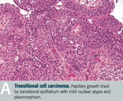 Papillary growth lined by transitional epithelium with mild nuclear atypica and pleomorphism