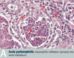 Neutrophilic infiltration (arrows) into renal interstitium