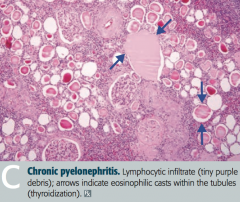 - Coarse, asymmetric corticomedullary scarring
- Blunted calyx
- Tubules can contain eosinophilic casts that resemble thyroid tissue (thyroidization of kidney) = picture