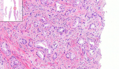 Prostate
- Fibromuscular stroma
- Cribriform growth of glands
- Invade prostatic capsule
- Perineural spread

Diagnosis?
Etiology?
Location?
Gleason score?