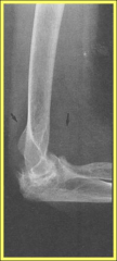 A 66 year old woman has chronic elbow pain and loss of function. She has severe morning stiffness and takes several medications for this. Exam reveals a flexion arc from 35-100 degrees with markedly limited rotation. What is the most appropriate d...
