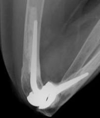 Total elbow arthroplasty is the most established definitive surgical treatment for severe rheumatoid arthritis. This patient has pain and loss of function with radiographs that show degenerative changes consistent with rheumatoid arthritis. This w...