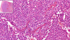 Supposed to look at testis:)

- No normal spermatic tubules
- Germinal cells with clear cytoplasm, and this tumor you see fibrovascular septa with lymphocytes
- Low mitotic activity

Diagnosis?
Tumor of which cells? 
Called what in females?