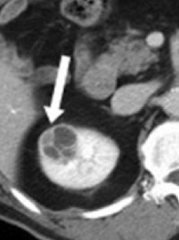 - Can be septated, enhanced, or have solid components, as seen on CT
- Require follow-up or removal due to risk of renal cell carcinoma