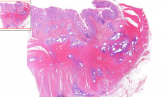Intestine

- Endometrial tissue inside intestinal wall
- Wall distended with fibrosis
- Endometrial glands within muscular layer, but when you look closer you see they are normal, so no adenocarcinoma
- Stroma around glands look like endometr...