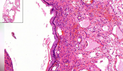 Ovary
- Loads of cysts 
- But look closer: There are tall columnar epithelium (coelomic) on base with mucin production

Diagnosis?
Etiology?
What is coelomic epithelium?
2 types of epithelioid stromal tumors? (most common of ovaries)