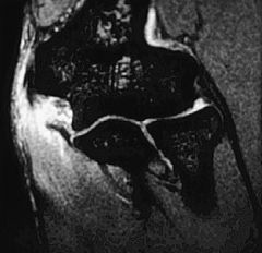 1-MR-arthrogram diagnostic->full-thickness & partial undersurface tears, r/o capsular "T-sign" w/ contrast extravasation; dx=Medial UCL Inj w/Attenuation/rupture ->UCL elbow leading -valgus instab
1.1-Dynamic US=can eval laxity w/valgus stress dy...