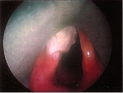 the glottis
- most in the anterior 2/3rd of true vocal fold