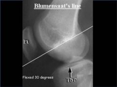 Which of the following best describes the xray landmarks on a lat xray for locating the fem attachment of the (MPFL) during recon? 1.  The intersection of a line extended from the middle of the shaft and Blumensaat's line 
2.  Anterior to a line ...