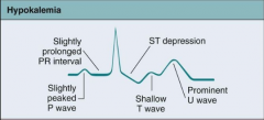 ST segment depression
Flattened T wave Presence of U wave Prolonged QRS Ventricular dysrhythmias Bradycardia