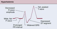Tall, peaked T wave     
Prolonged PR interval
ST segment depression
Loss of P wave
Widening QRS
Ventricular fibrillation
Ventricular standstill