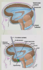 Cerebral shunt - access lateral ventricle through posterior cranium. Drain fluid to abdomen.
Endoscopic third ventriculostomy - Drill a hole in third ventricle, allowing CSF flow to ventral subarachnoid space.