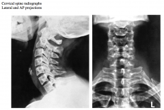Note that while all cervical vertebrae are seen in the lateral projection, the atlas (C1) and axis (C2) are not seen in the AP projection. Why is this? 


 


Identify the intervertebral discs and number the vertebral bodies.

Identify the ...