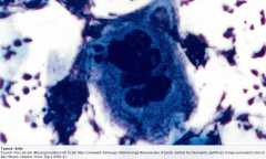 - Positiv = Nachweis akantolytischer Riesenzellen (Tzanck-Zellen) in der May-Grünwald-Färbung (Exfoliativzytologie)
- Positiv bei Pemphigus vulgaris, Herpes-simplex Typ 1 (HSV-1) (Stomatitis aphthosa), Varizella-Zoster-Virus (Windpocken bzw. Gü...