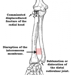 Essex-Lopresti : 
Fracture de la tête radiale avec une dislocation de l’articulation radio-ulanaire. 
Compression longitudinale (Axiale) de l’avant-bras.
Tx: 
