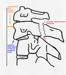 Hangman’s fracture Fracture-dislocation de l’atlas (C1) et de l’axis (C2), atteinte le la pars-interticularis de C2 et destruction de l’articulation C2-C3. Séparation entre le 2e et le 3e corps vertebral de l’antérieur vers postérie...