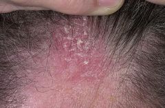 Seborrheic dermatitis - clinical features