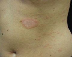 - Papulosquamous erruption - initially "herald patches" that resemble ring worm (multiple round/oval patches) appear and then a generalized rash with multiple oval-shaped lesions appear. The rash is typically described as having a Christmas tree-t...