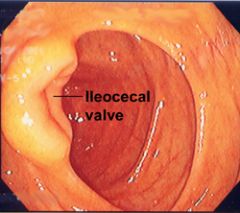 ileocecal valve