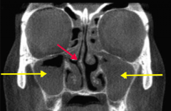 Rhinosinusitis
- Often in maxillary sinuses in adults (yellow arrows)