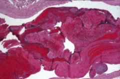 Lines of Zahn are interdigitating areas of pink (platelets, fibrin) and red (RBCs) found only in thrombi formed BEFORE death
