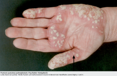 - Assoziation zu Nikotinabusus
- Weiße, sterile Pusteln auf erythematösem Grund im Bereich der Handflächen, Fußsohlen und Finger
- Protrahierter Verlauf bei gutem  Allgemeinbefinden
- Gleichzeitiges Auftreten von Psoriasis vulgaris ist möglich