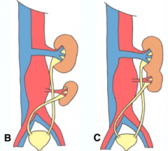 What is the term for both kidneys being on the same side of the body?