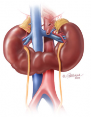 - 1 / 425-600 live births
- Often occurs because of fusion of the caudal poles of the kidney
- Ascent to normal position is blocked by inferior mesenteric artery
- May be associated with additional anomalies