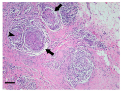 rare AUTOIMMUNE chronic non-caseating GRANULOMATOUS inflammation = progressive CHOLESTASIS, CIRRHOSES & portal HTN
- obstructive jaundice, AMA (M2 antimicrobial ab's), IgM
- F~50yrs