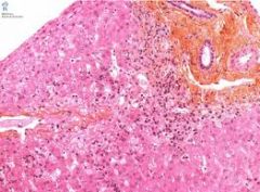 INTERFACE hepatitis
necrosis
eosinophils, lymphocytes & inflam cells
fibrosis / cirrhosis