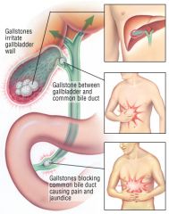 gallstones can cause what 4+ syndromes/ diseases