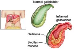 inflammation of the GALLBLADDER, GS in cystic duct---> obstruction of bile outflow
commonly assoc with gallstones --> infection 
can cause: empyema, rupture, peritonitis, intesne adhesions 2-3days
