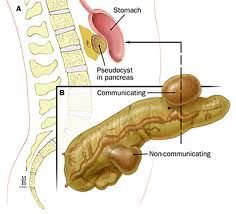 complications of ACUTE pancreatitis (6)