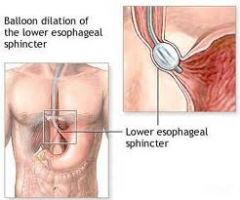 DILATATION (balloon eg for achalasia)

STENT (malignancy)