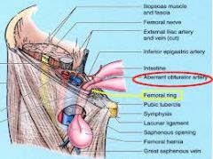 anterior: inguinal lig
lateral: femoral vein