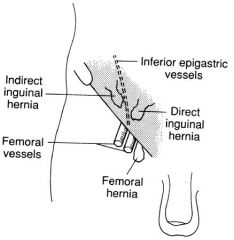 INDIRECT; lateral to inf epigastric vessels, through inguinal canal --> scrotum
DIRECT: medial to inf epi vessels, directly through wall. REAPPEARS with cough test