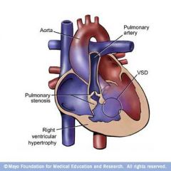 4 components: po stenosis, VSD, RVH, over-riding aorta