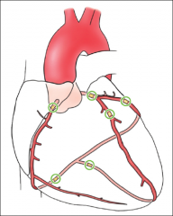 irreversible necrosis of myocardium due to coronary artery occlusion: 
- LAD > RCA > circumflex > LCA (mainstem)