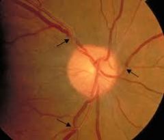 1-2: moderate- severe retinal arteriole NARROWING

2: arteriovenous NICKING