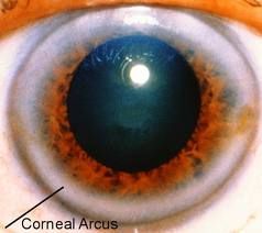 xanthelasma (eyes)
xanthomas (skin)
corneal arcus (can be normal >50)