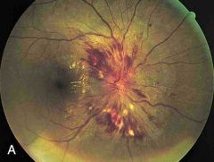 bilateral optic nerve PAPILLOEDEMA