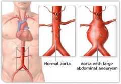 abnormal DILATATION & reduced elasticity of artery wall
media weakened by atherosclerosis ---> RUPTURE!