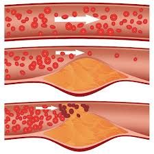 arthero: INTIMAL 
arterio: small arteries/ arterioles, hyaline & hyperplastic (DM & HTN)