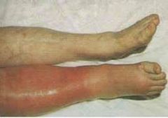 unilateral
calf: pain, red, inflamed, warm, pitting oedema, prominent superficial veins
fever