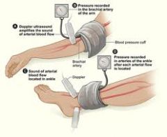 ★ANKLE-BRACHIAL PRESSURE INDEX★ (leg BP)
<1 = PAD

DUPLEX USS- artery flow
(MRA or arteriography)