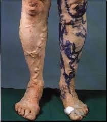 dilated veins from venous HTN
pain, cramps, tingling, heaviness
oedema, ulcers, tenderness
gravitational
