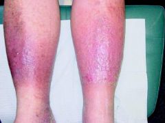 irreversible skin damage from sustained venous HTN
relief on raising
--> chronic venous ulceration