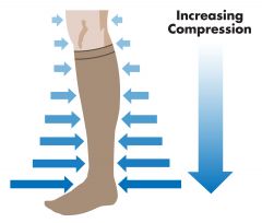 ★COMPRESSion stockings★ + pt EDUCATION
ulcers- topical
SURGICAL removal
SCLEROSANT therapy
